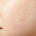 3 PCS Acne Tool Set Treatment Acne Scar  Pimples Sticker