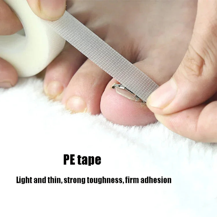 Orthopedic Buckle Toe Nail Groove Ingrown Nail Corrector, No. 36 Positive Nail Buckle, No. 38 Positive Nail Buckle, No. 40 Positive Nail Buckle, No. 42 Positive Nail Buckle, No. 44 Positive Nail Buckle, No. 36 Set, No. 38 Set, No. 40 Set, No. 42 Set   ...